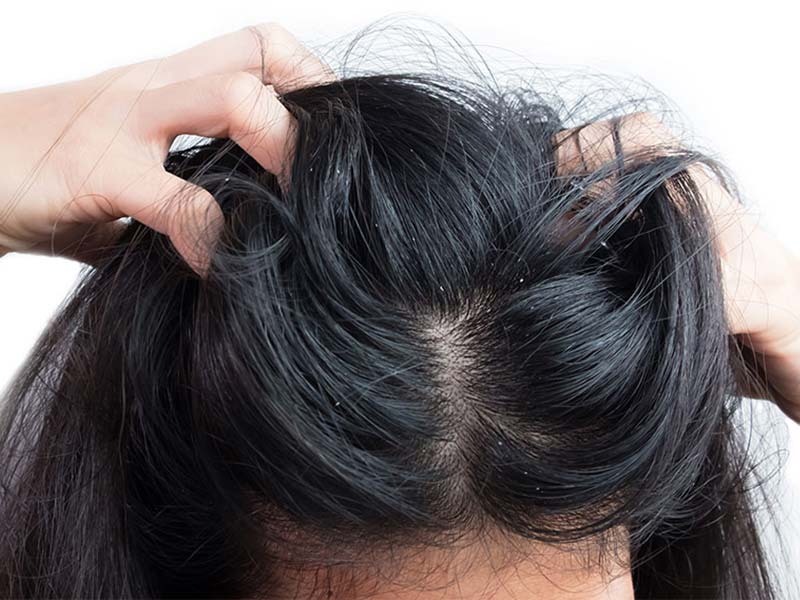 how to get rid of fleas on humans?