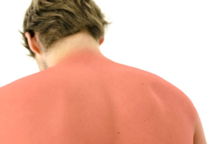 How To Get Rid Of Sunburn Redness Overnight?