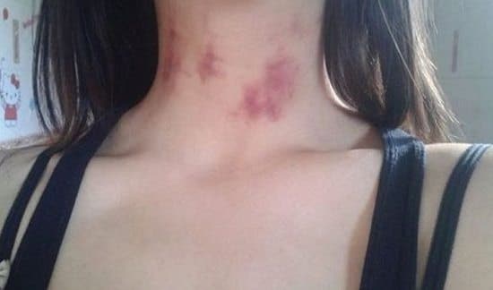 how to get rid of a hickey fast