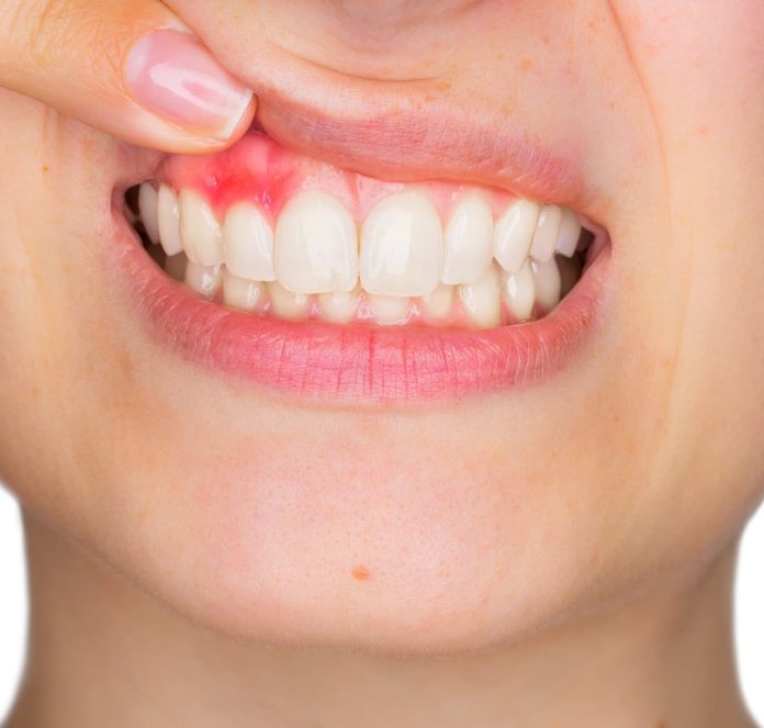 how to get rid of a tooth abscess without going to the dentist