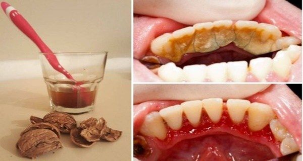 How To Remove Tartar From Teeth Without Dentist?
