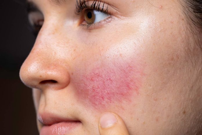 how to get rid of redness on face