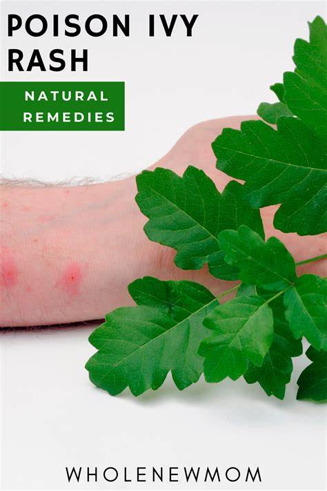 How To Get Rid Of Poison Ivy Rash?
