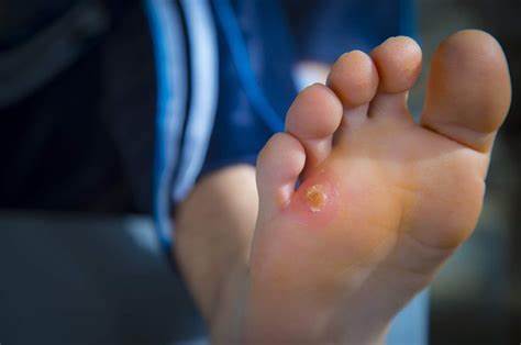 How To Get Rid Of Corns On Feet?