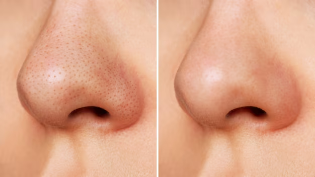 how to get rid of blackheads on nose