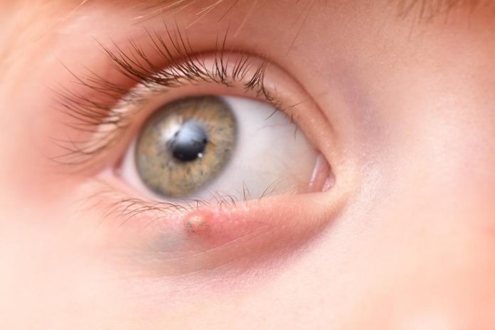 How to Get Rid of an Eye Stye?