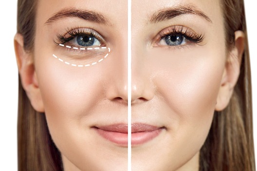How To Get Rid Of Under Eye Bags Permanently?