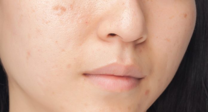 How to Get Rid of Bumps on Face?