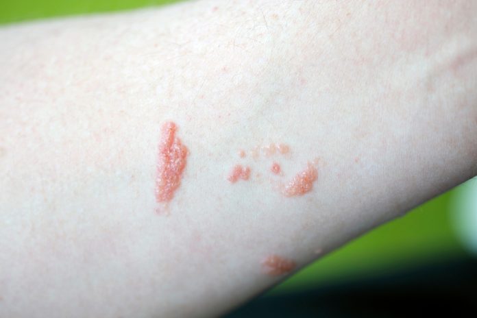 how to get rid of poison ivy rash overnight