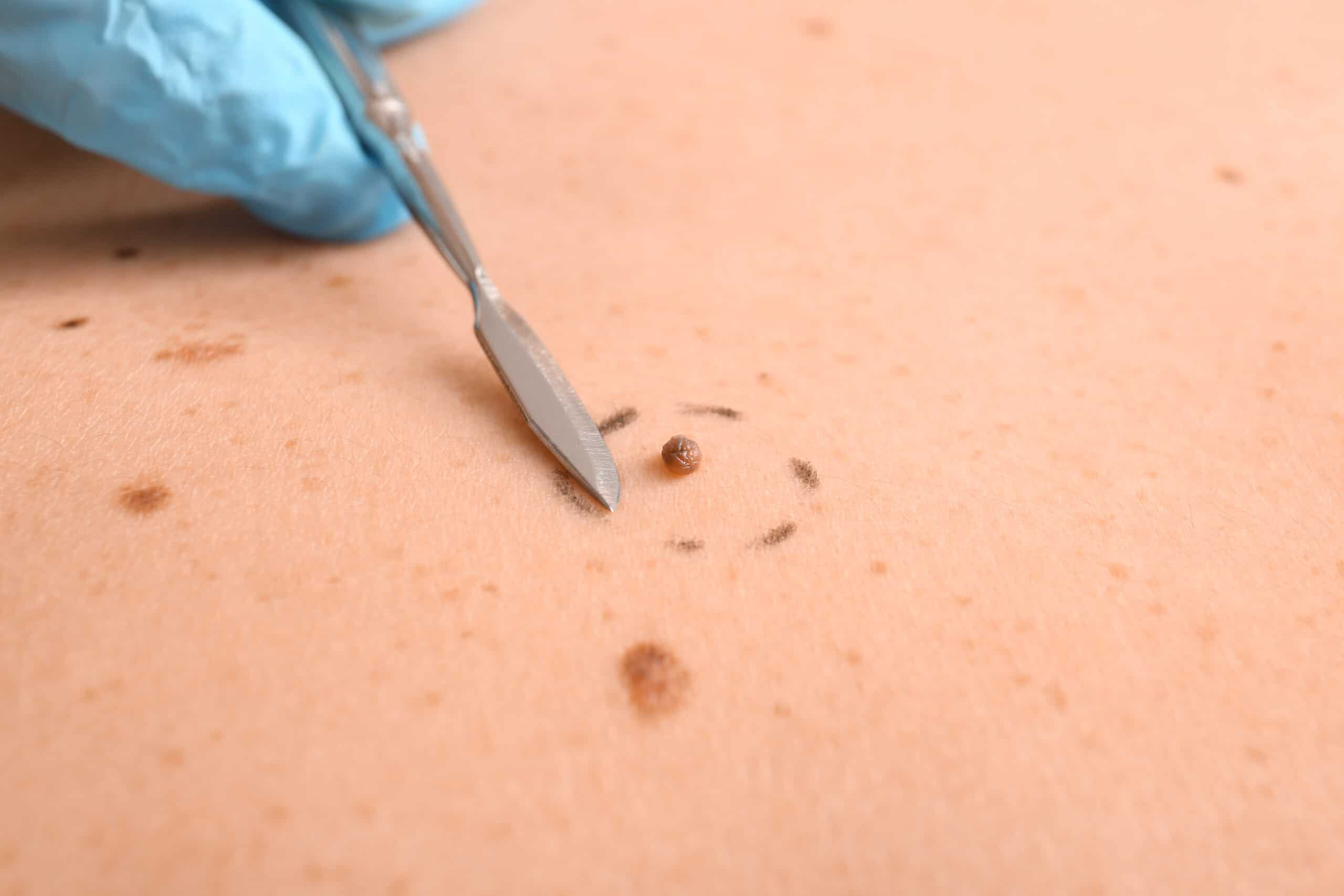 How to Get Rid of a Skin Tag?