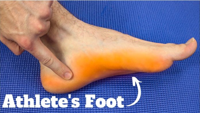 How to Get Rid of Athlete’s Foot Fast?