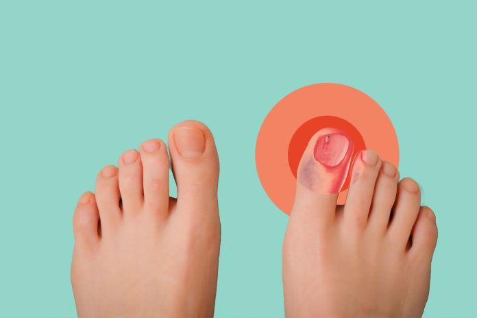 how to get rid of an ingrown toenail